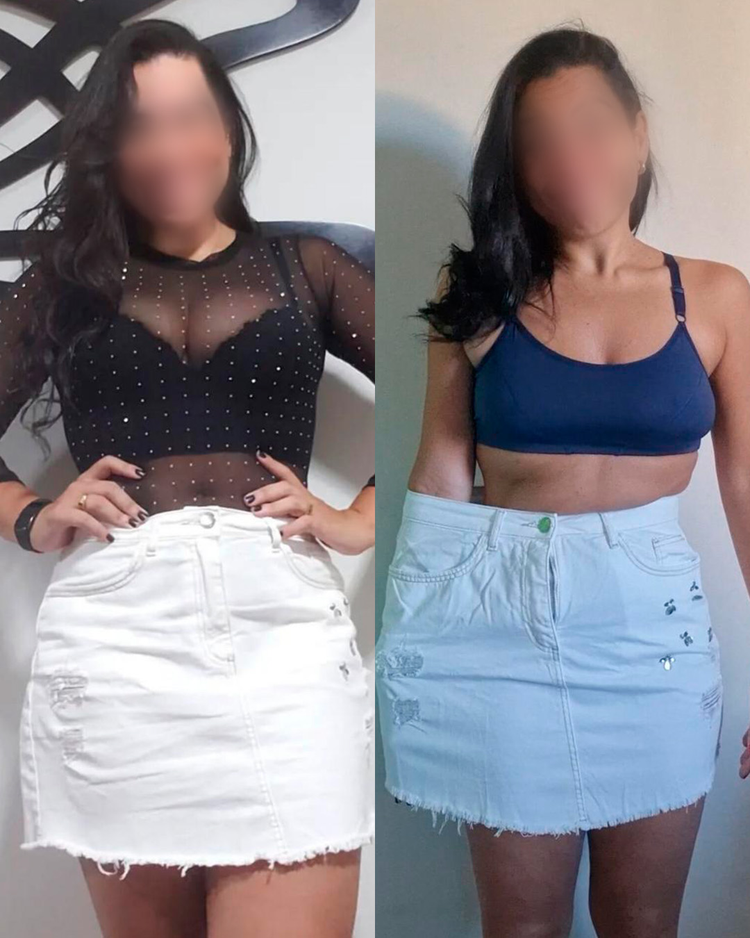 Antes e depois de paciente acompanhado pelo Dr. Vagner de Mello — resultado 1