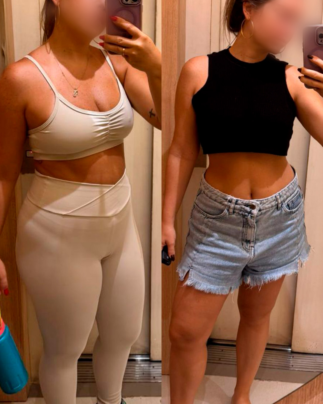 Antes e depois de paciente acompanhado pelo Dr. Vagner de Mello — resultado 2