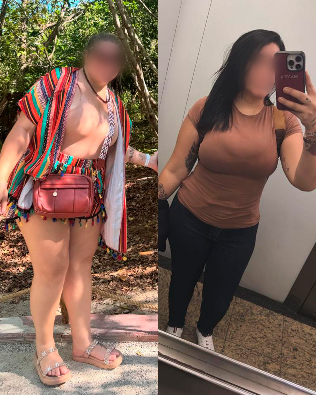 Antes e depois de paciente acompanhado pelo Dr. Vagner de Mello — resultado 5