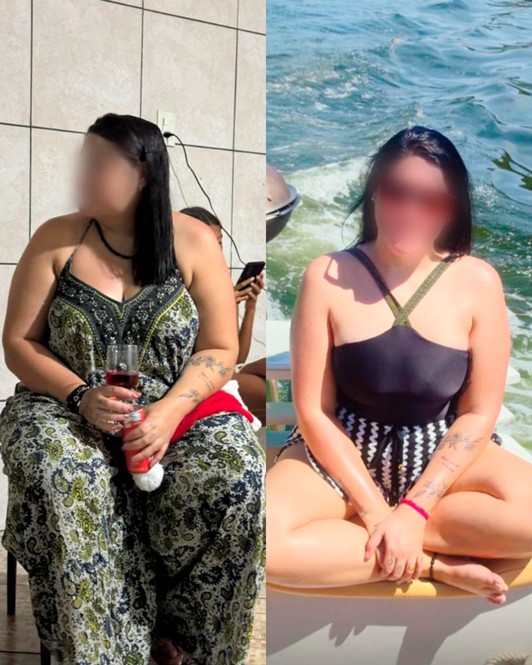 Antes e depois de paciente acompanhado pelo Dr. Vagner de Mello — resultado 4